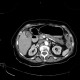IPMN, intrapapillary mucinous neoplasm, central type, colitis: CT - Computed tomography